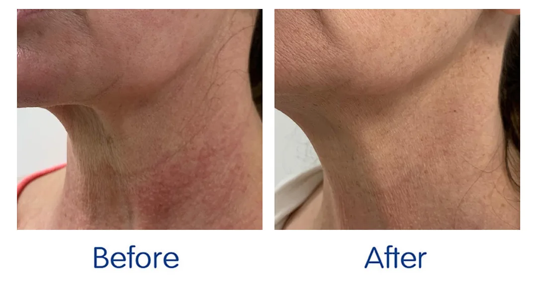 ba-microneedling3